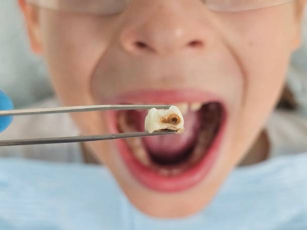 Best Emergency Treatment for Dental Infections or Abscesses in , MS